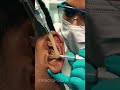 Ear Vacuum Comedone Extraction | 4K Macro ASMR #earcleaning