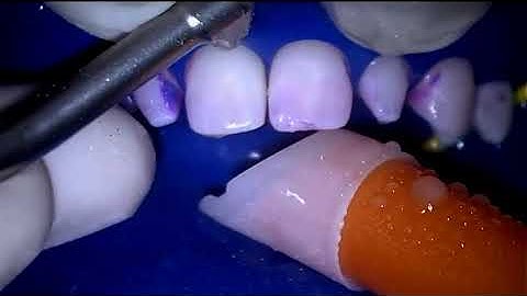 The Bioclear Blaster   Efficient Biofilm Removal