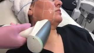 Sublime Laser at Body+Beauty Lab, Philadelphia