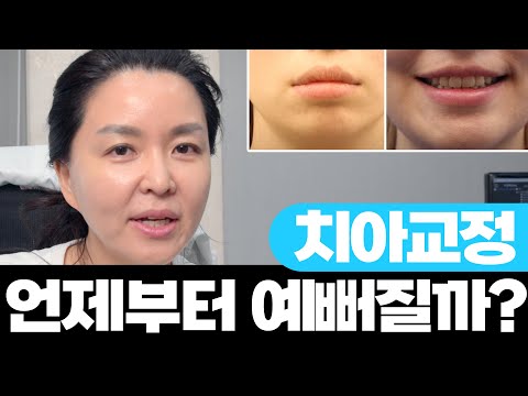   그래서 교정 시작하고 언제부터 예뻐지냐고요