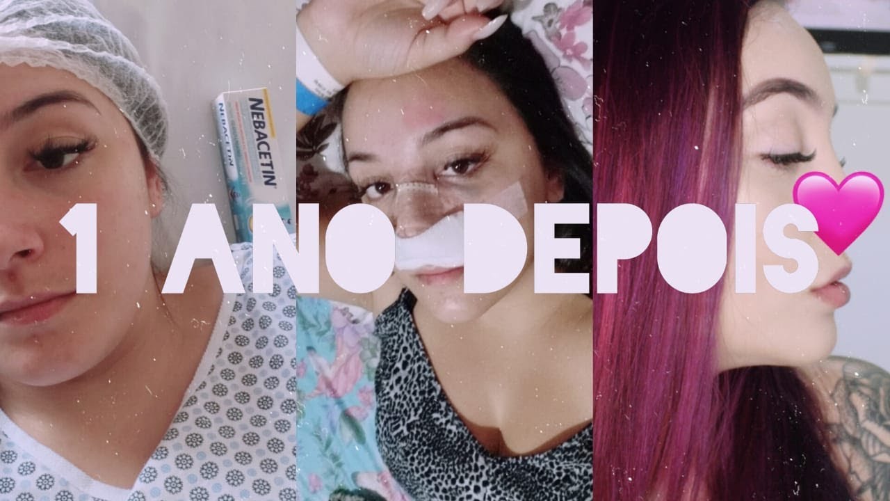 1 ANO DE SEPTOPLASTIA Antes X Depois P s Operat rio Como Espirrar 