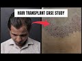 Fue hair transplant  hair transplant india  before and after  dmc trichology