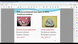principles of Removable partial denture design  lec 14