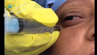 Step by step phaco surgery: Peribulbar vs retrobulbar anesthesia