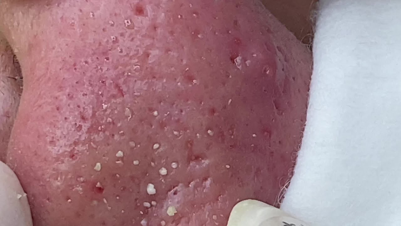 Treat Adult Acne | Điều Trị Mụn Cho Người Lớn - SacdepSpa#153