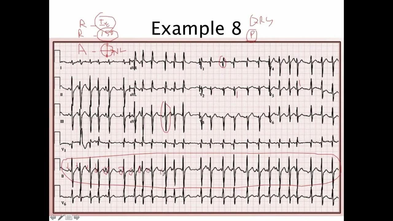 39 EKG case study MAT ករណីសិក្សារ ECG Multifocal atrial tachycardia