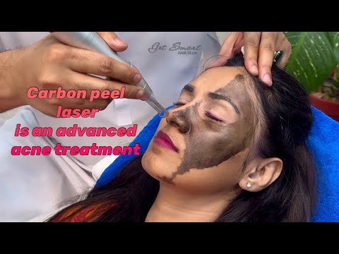 Carbon peel laser is an advanced acne treatment #getsmarthairclub #peshawar