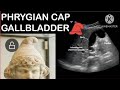 Phyrigian cap gallbladder 