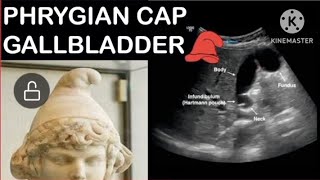 Phyrigian cap gallbladder 