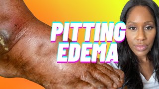 What is PITTING EDEMA? How is it Diagnosed? What Causes It? A Doctor Explains!