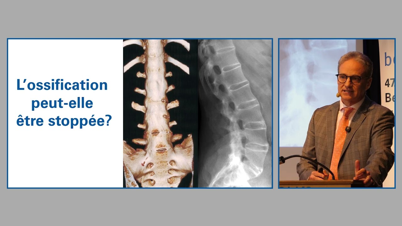 L’ossification (ankylose) de la colonne vertébrale en cas de spondylarthrite ankylosante
