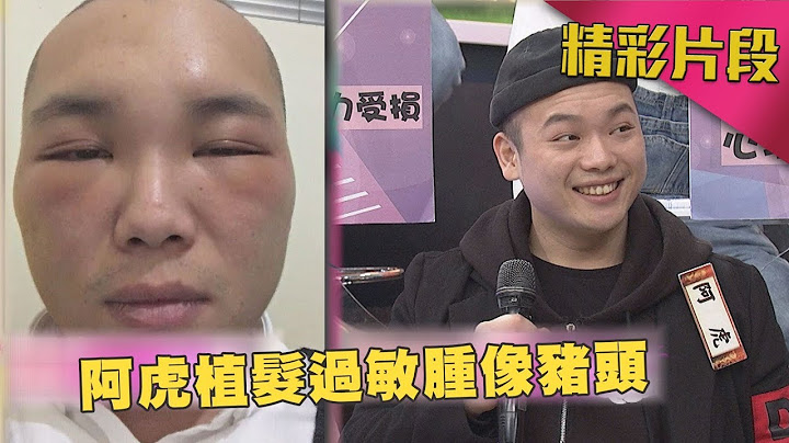 麻辣天后传|这是谁啊？阿虎植发过敏　竟肿像猪头！|2018.02.26 - 天天要闻