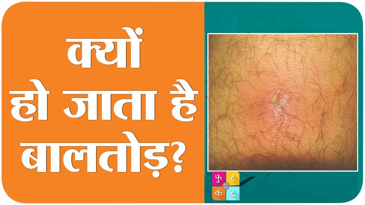 बालतोड़ यानी Boils होने की वो वजह नहीं है जो आप समझते हैं | Tan Ki Baat|Sehat ep 139