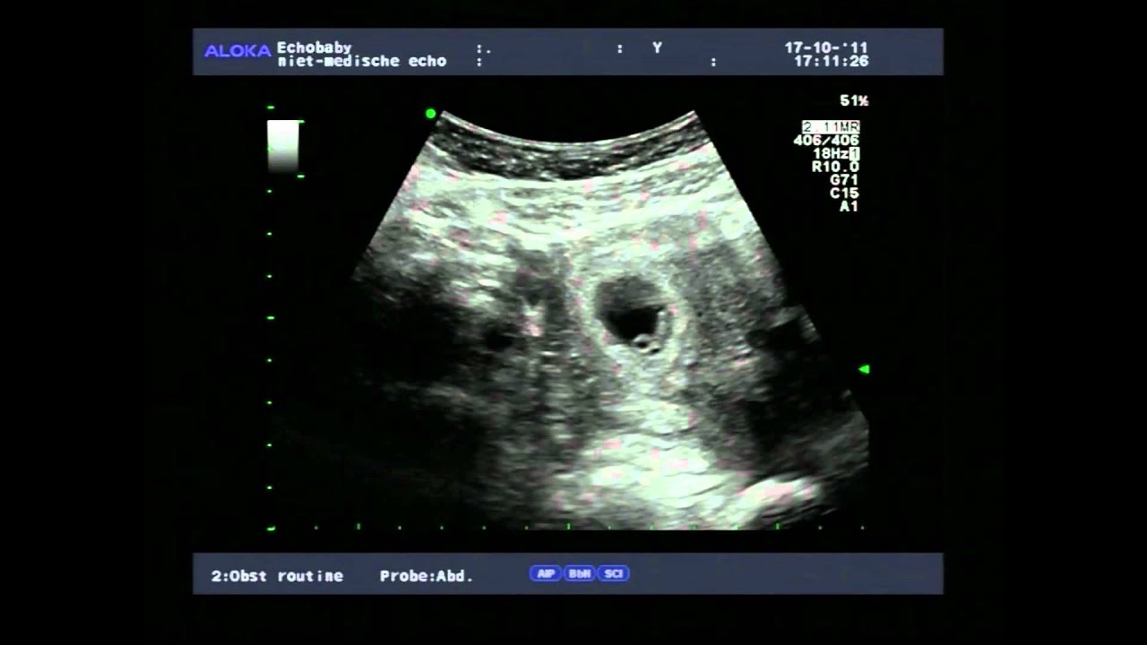 6 weken zwanger YouTube