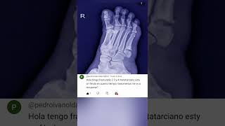 metatarsal fractures how long will it take for me to be well