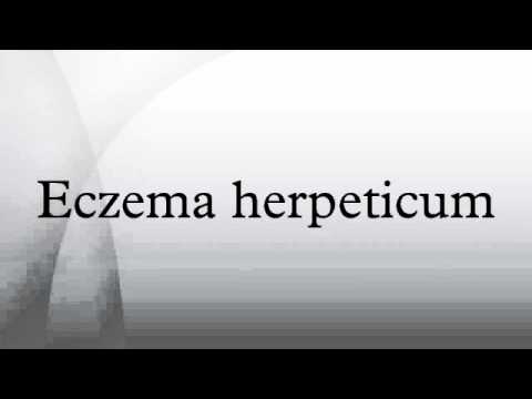 Eczema herpeticum