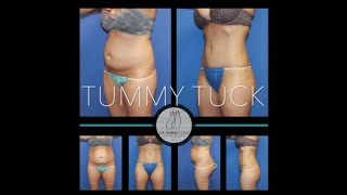 Tummy Tuck Before and After