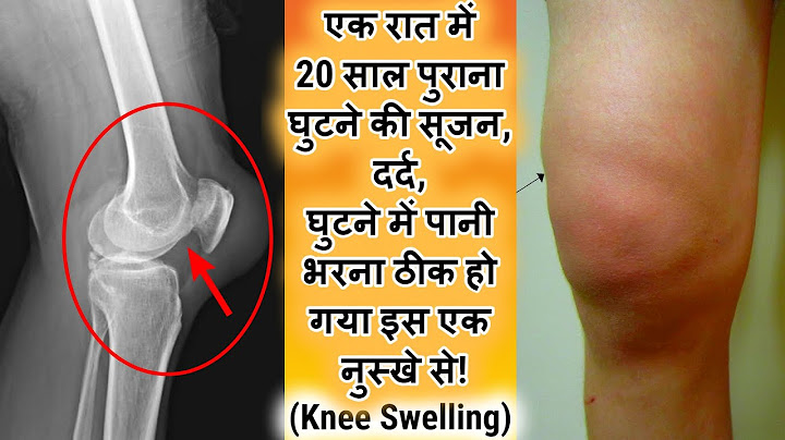 20 साल पुराना घुटने की सूजन, दर्द, घुटने में पानी भरना ठीक हो गया इस एक नुस्खे से| Swelling in Knee