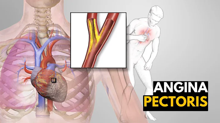 What is Angina Pectoris? Causes, signs and symptoms, Diagnosis and treatment. - DayDayNews