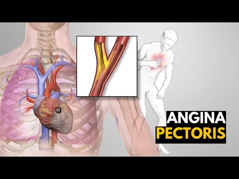 Video: Angina Pectoris - Symptom, Behandling, Prognos