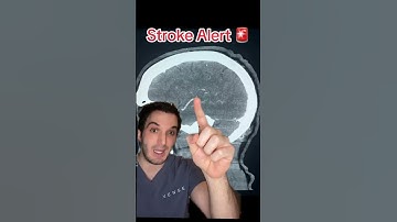 CODE STROKE - role of imaging in diagnosis and treatment of a stroke
