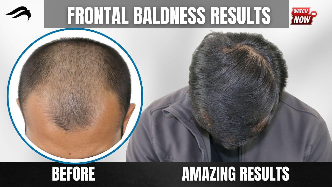 Hair Transplant In Coimbatore | Best Price Clinic Doctor & Results Of Hair Transplant in Coimbatore