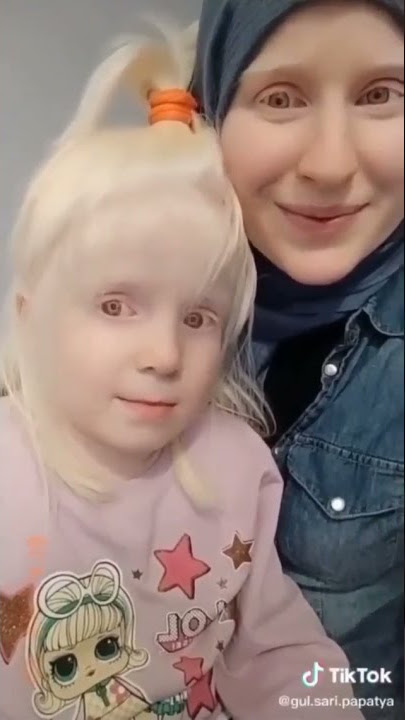 #المهق #albinism