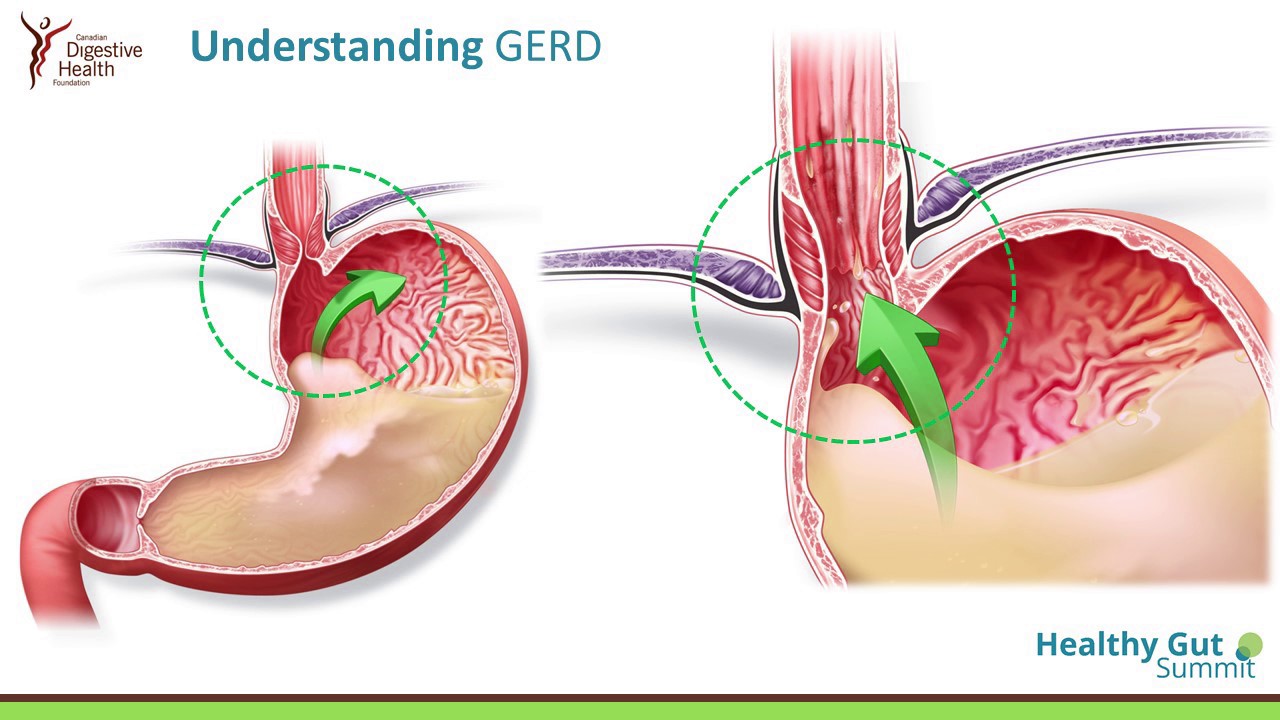 Acid reflux stomach ulcer symptoms