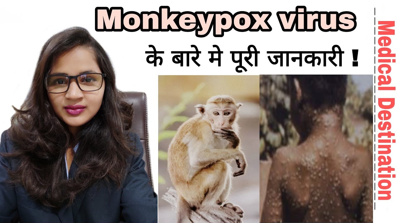 Monkeypox virus | cause | symptoms | prevention & treatment in  hindi | medical Destination |
