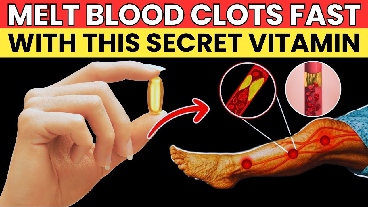 Best Vitamins to Prevent Blood Clots