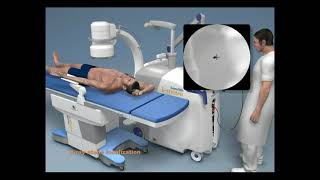 Sonolith Imove From Edap Tms
