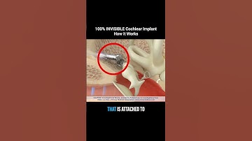 The New INVISIBLE Cochlear Implant