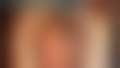 "Subluxated Lens in Marfan Syndrome: Iris Claw Lens Implantation Technique