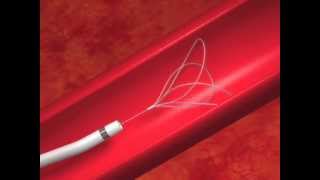EN Snare® Endovascular Snare & Catheter Animation