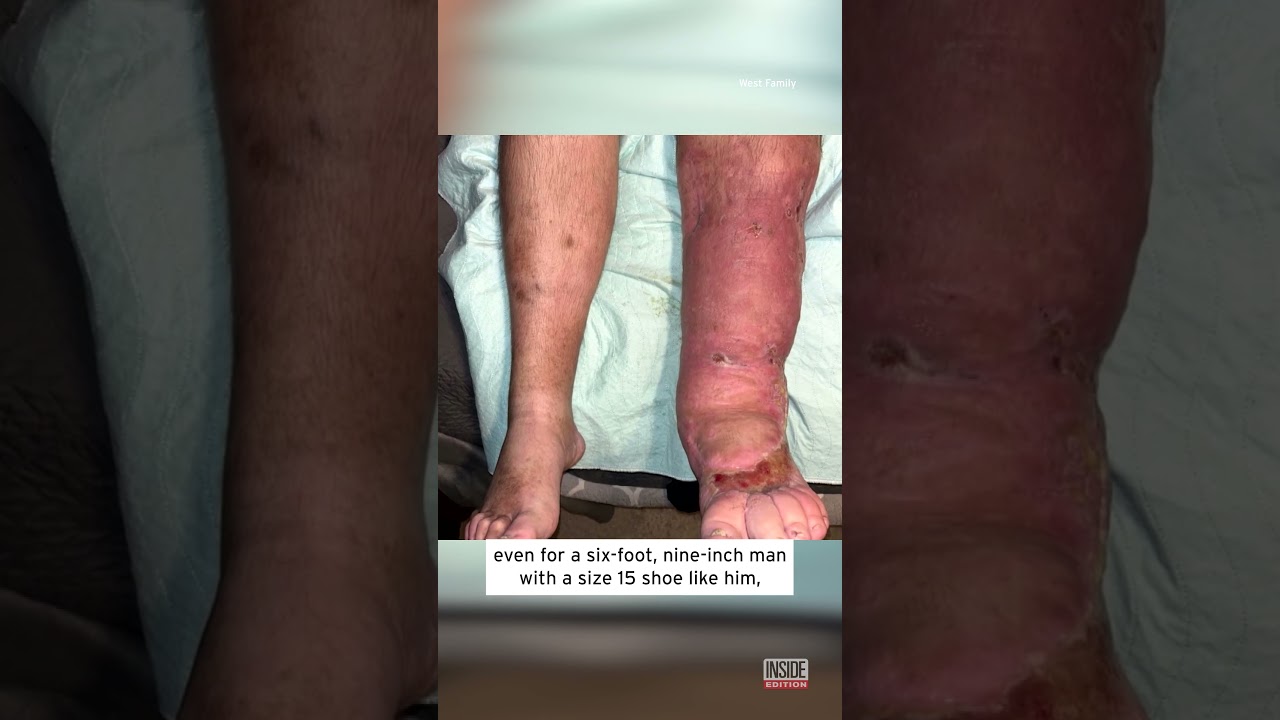 Florida Dad Loses Leg To Flesh-Eating Bacteria #shorts