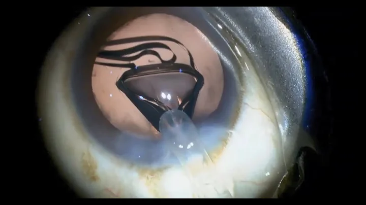 Plus1 EMV | RayOne EMV Intraocular lens implantation with cataract surgery by Dr. Michael George