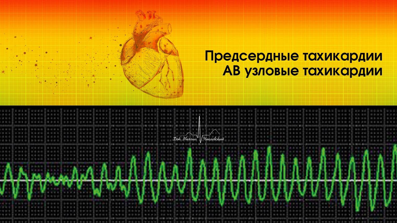 Предсердные тахикардии. АВ узловые тахикардии. - YouTube