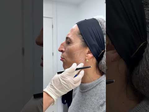 Armonización facial: El secreto de un rostro natural y equilibrado | Clínica AGL