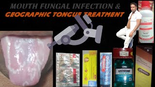 Geographic tongue ? , mouth fungal infection best treatment