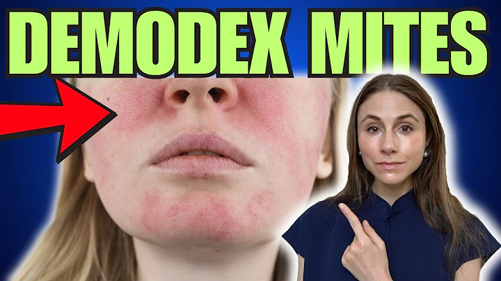 Demodex Mites: The Good, The Bad, & The Ugly