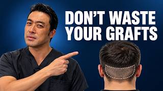 Avoid These 5 Mistakes Before Getting a Hair Transplant