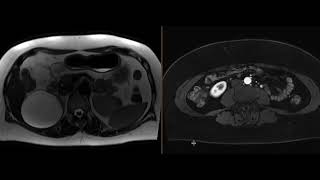 Fibromuscular dysplasia