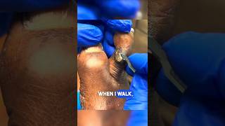 KISSING CALLUSES wart callusremoval