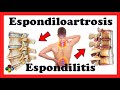 Espondiloartrosis VS Espondilitis anquilosante