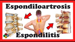 🔎 Espondiloartrosis - Espondilitis anquilosante DIFERENCIAS ¿Que son?