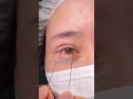 【二重整形/ASMR】アイプチの代償?三重瞼の治し方#shorts