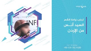 تجربة زراعة الشعر في تركيا مركز انفينتي هير | Infinity Hair transplant turkey