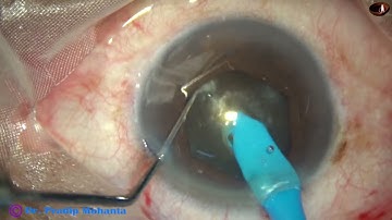 Overcoming 3 challenges : Hard nucleus, Small pupil and Floppy iris - Pradip Mohanta, 25 June, 2023