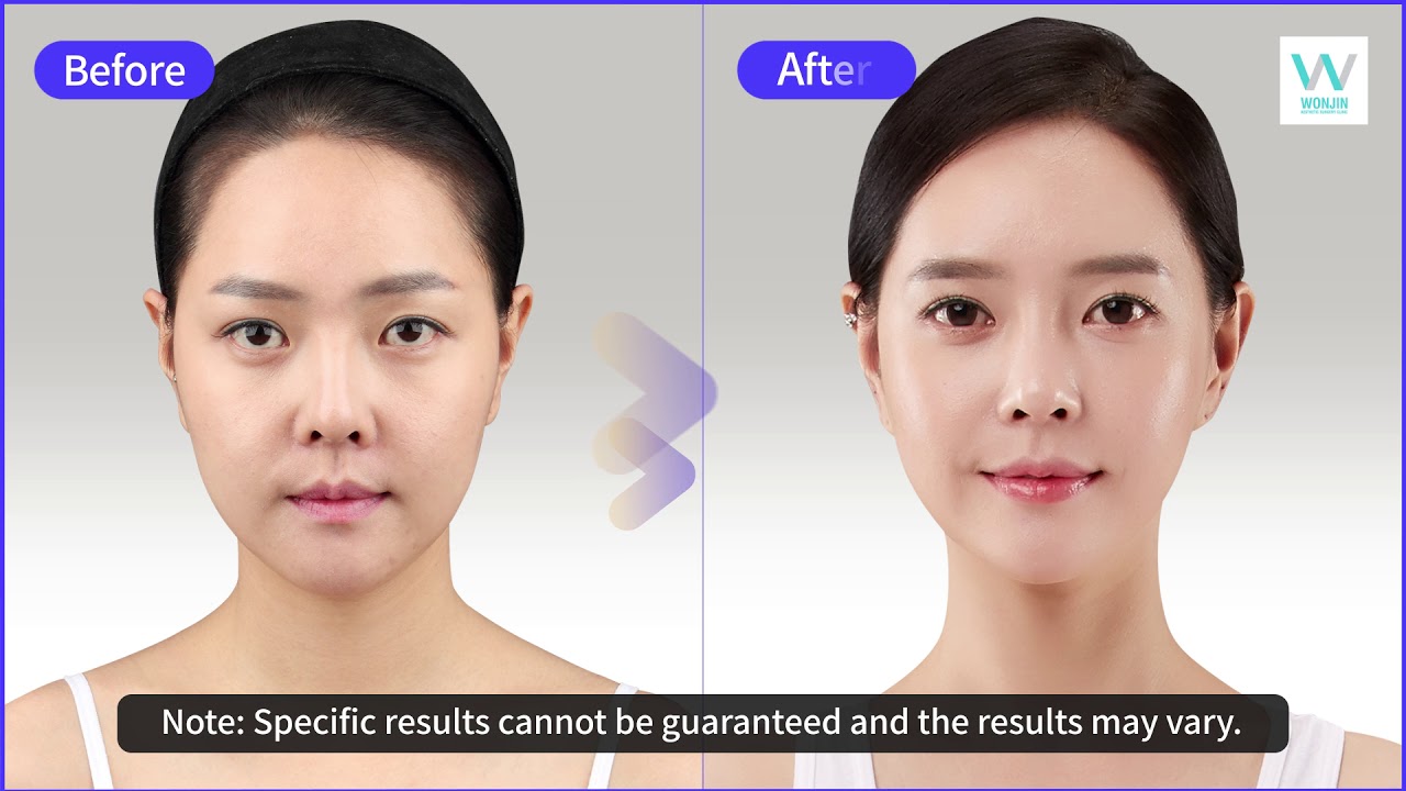 Before and After Plastic Surgery in Korea