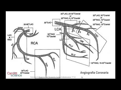 Vídeo: Angiografía Coronaria: Indicaciones, Contraindicaciones